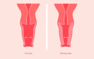 Rejuvenecimiento vaginal: qué es, para quién está indicado y qué tratamientos existen sin cirugía