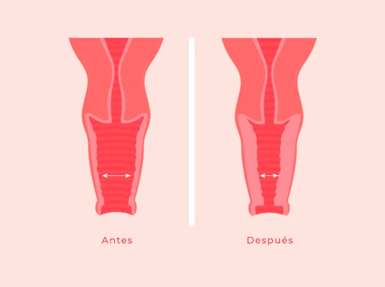 Rejuvenecimiento vaginal: qué es, para quién está indicado y qué tratamientos existen sin cirugía