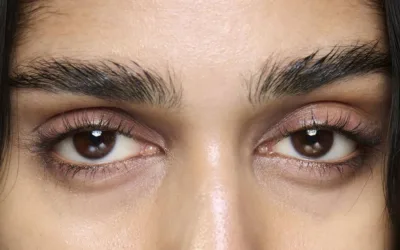 Ojeras oscuras: causas y tratamientos