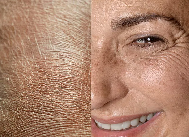 Piel seca y piel deshidratada - centro de estetica avanzada malaga - clinica baños