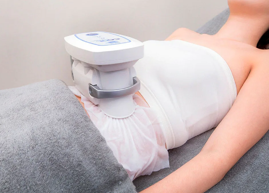 Criolipólisis para grasa resistente en Málaga