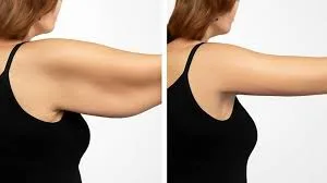 Brazos flácidos: ¿Indiba o HIFU para reafirmar?