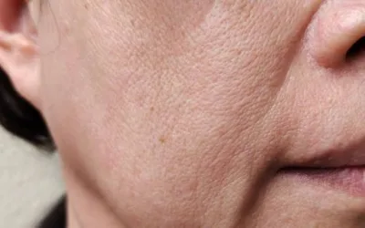 ¿Qué tratamiento es mejor para la flacidez facial?