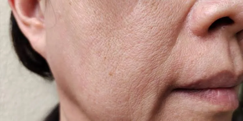 flacidez facial - centro de estetica avanzada malaga