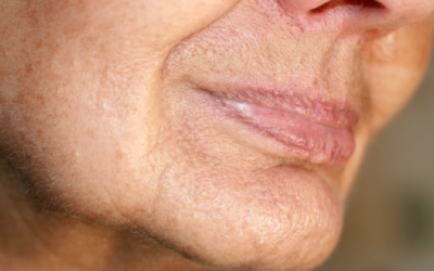 Manchas, arrugas o flacidez: ¿qué problema facial debemos tratar primero?