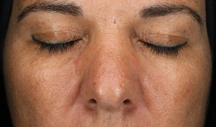 Microneedling Málaga con AXIÓN®