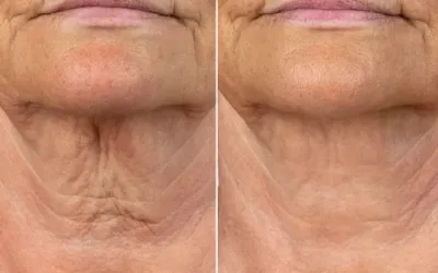 Tratamiento flacidez cuello Málaga | Clínica Baños