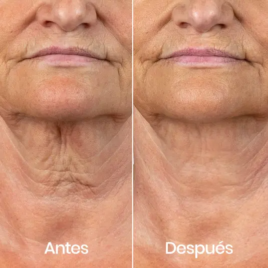 Tratamiento flacidez cuello Málaga | Clínica Baños