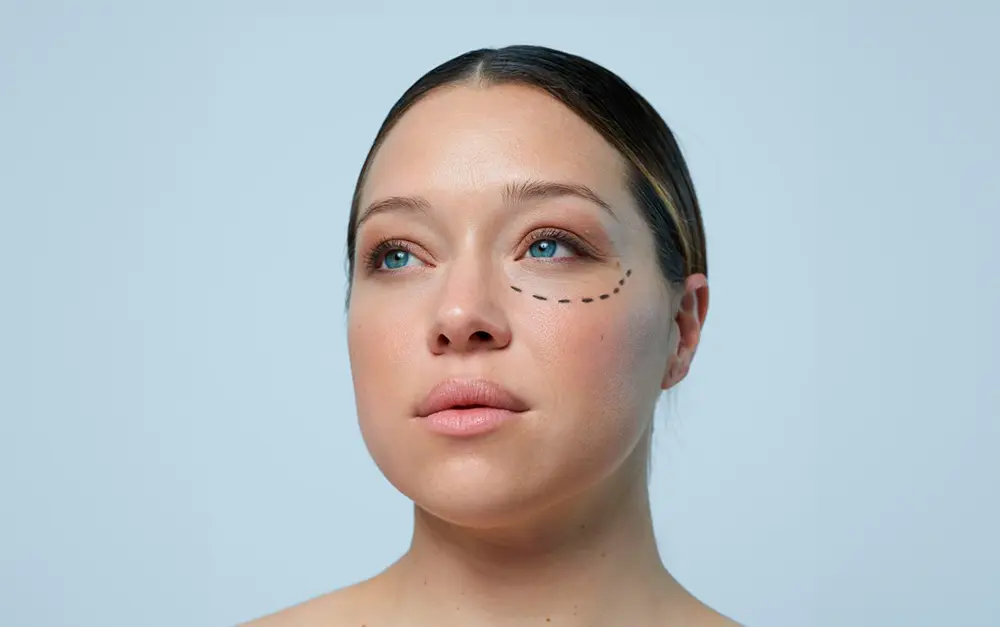 Tratamiento ojeras Málaga