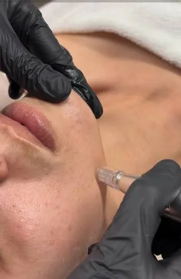 Microneedling AXIÓN Málaga | Clínica Baños