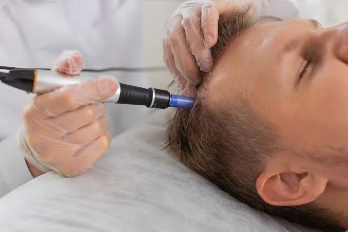 Microneedling capilar Málaga con AXIÓN® - clinica baños málaga - centro de estética avanzada